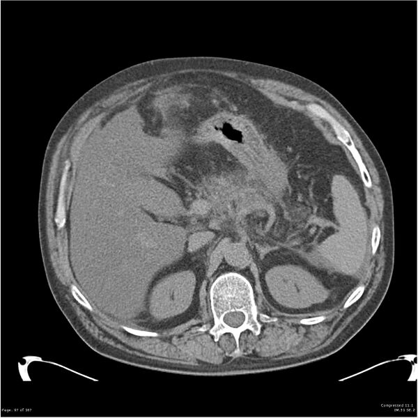 File:Acute pancreatitis (Radiopaedia 19135-19116 Axial non-contrast 11).jpg