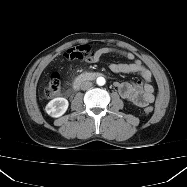 File:Acute pancreatitis (Radiopaedia 22572-22596 Axial C+ arterial phase 40).jpg