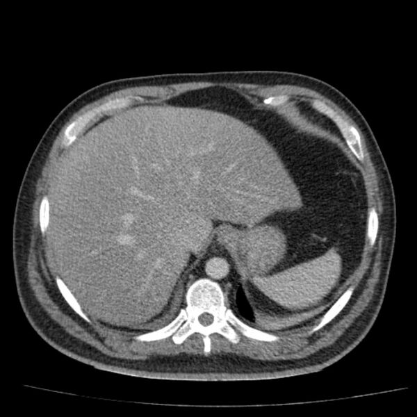 File:Acute pancreatitis (Radiopaedia 26663-26813 Axial C+ portal venous phase 16).jpg