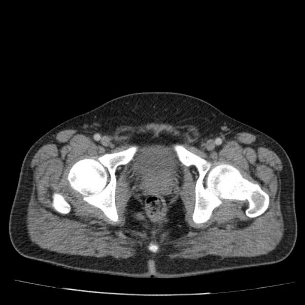 File:Acute pancreatitis (Radiopaedia 26663-26813 Axial C+ portal venous phase 85).jpg