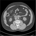 Acute pancreatitis - mild (Radiopaedia 27796-28033 Axial non-contrast 27).jpg