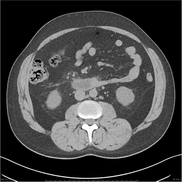 File:Acute pancreatitis - mild (Radiopaedia 27796-28033 Axial non-contrast 27).jpg