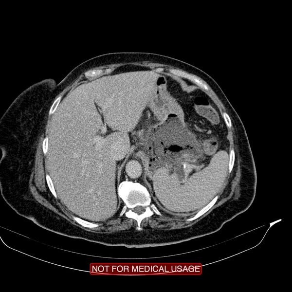 File:Acute pancreatitis with infected necrosis (Radiopaedia 26454-26585 Axial C+ delayed 4).jpg