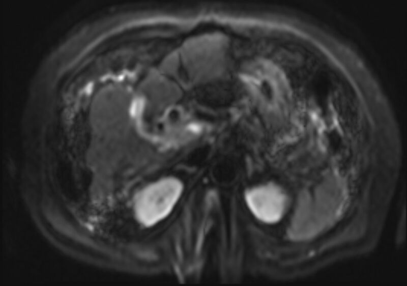 File:Acute portal vein thrombosis (Radiopaedia 73198-83925 Axial DWI 15).jpg
