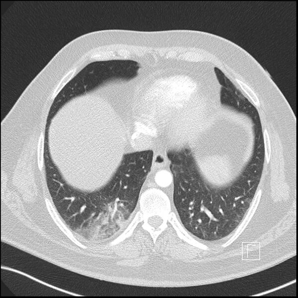 File:Acute pulmonary embolism with pulmonary infarct (Radiopaedia 73062-83768 Axial lung window 15).jpg