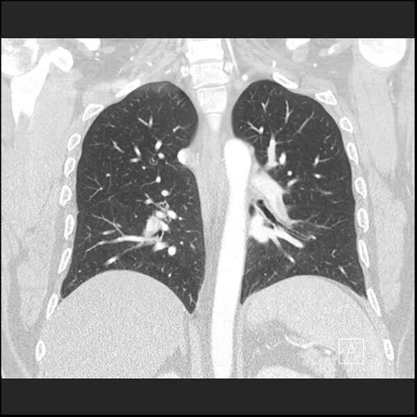 File:Acute pulmonary embolism with pulmonary infarct (Radiopaedia 73062-83768 Coronal lung window 47).jpg