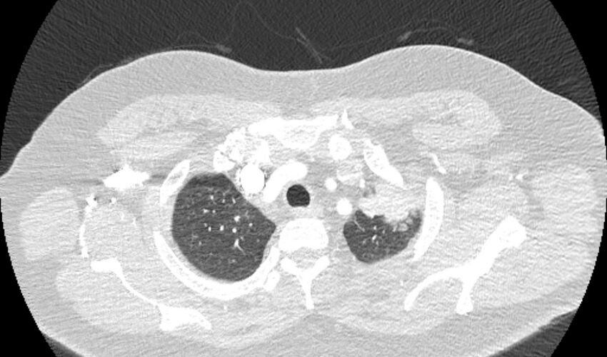 Acute pulmonary embolism with pulmonary infarcts (Radiopaedia 77688-89908 Axial lung window 6).jpg