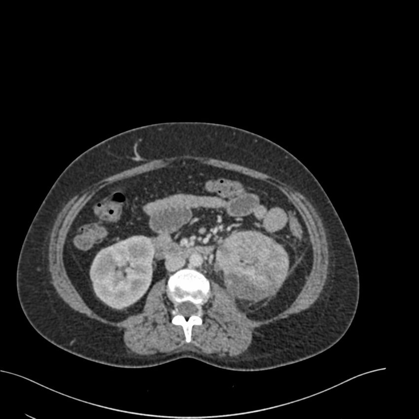 Acute pyelonephritis with renal vein thrombosis (Radiopaedia 58020-65053 Axial renal parenchymal phase 88).jpg