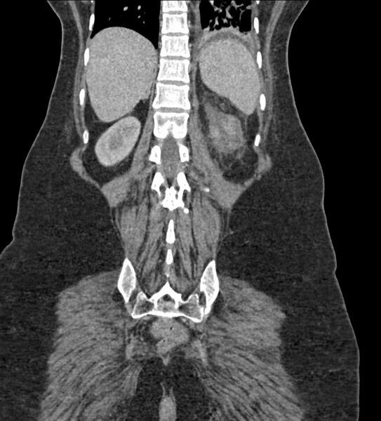 File:Acute pyelonephritis with renal vein thrombosis (Radiopaedia 58020-65053 Coronal renal parenchymal phase 104).jpg