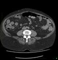 Acute renal failure post IV contrast injection- CT findings (Radiopaedia 47815-52557 Axial non-contrast 49).jpg