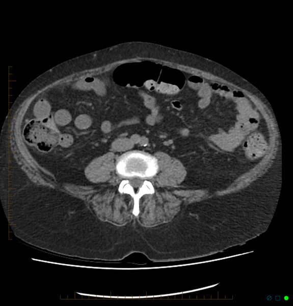 File:Acute renal failure post IV contrast injection- CT findings (Radiopaedia 47815-52557 Axial non-contrast 49).jpg