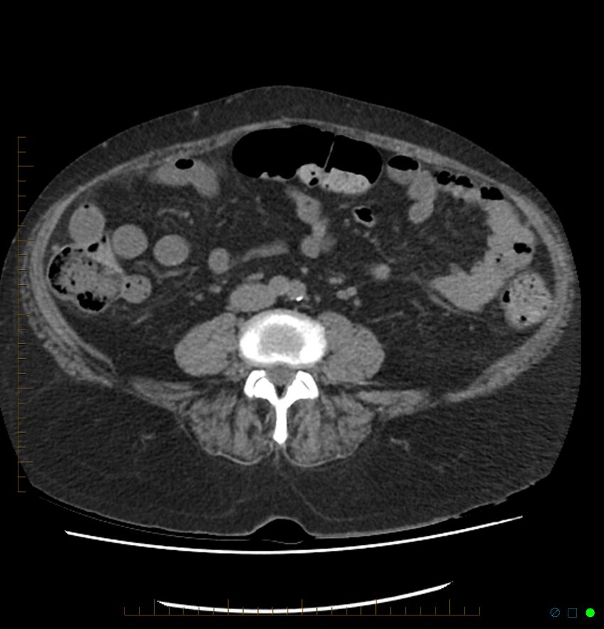 Acute renal failure post IV contrast injection- CT findings (Radiopaedia 47815-52557 Axial non-contrast 49).jpg