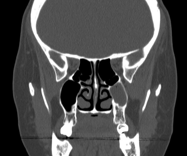 File:Acute sinusitis (Radiopaedia 22419-22455 Coronal bone window 24).jpg