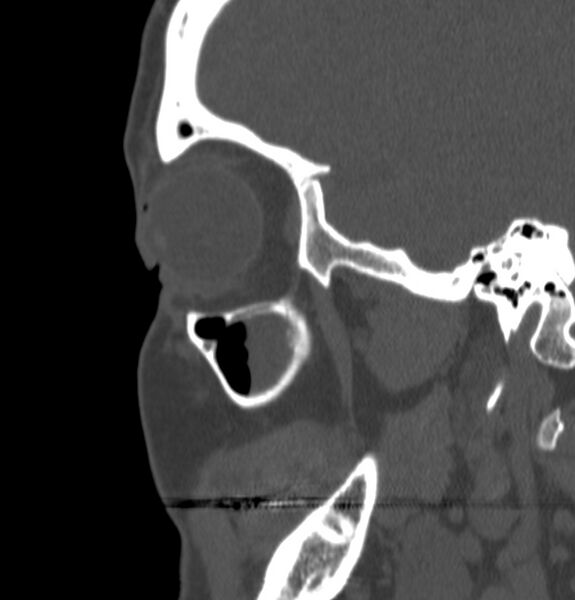 File:Acute sinusitis (Radiopaedia 22419-22455 Sagittal non-contrast 22).jpg