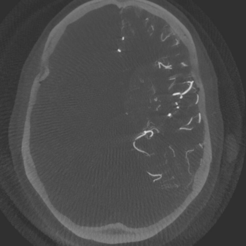 Acute subarachnoid hemorrhage and accessory anterior cerebral artery (Radiopaedia 69231-79010 C 30).jpg