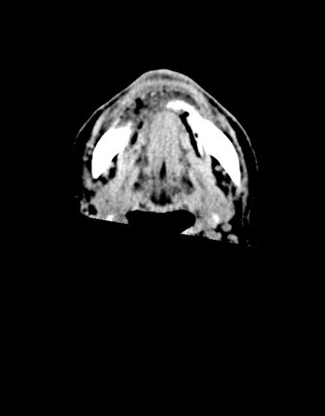 File:Acute superior cerebellar artery territory infarct (Radiopaedia 84104-99359 Axial non-contrast 82).jpg
