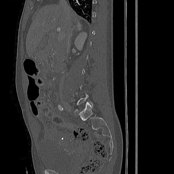 File:Acute vertebral body compression fractures (Radiopaedia 31757-32693 Sagittal bone window 40).jpg