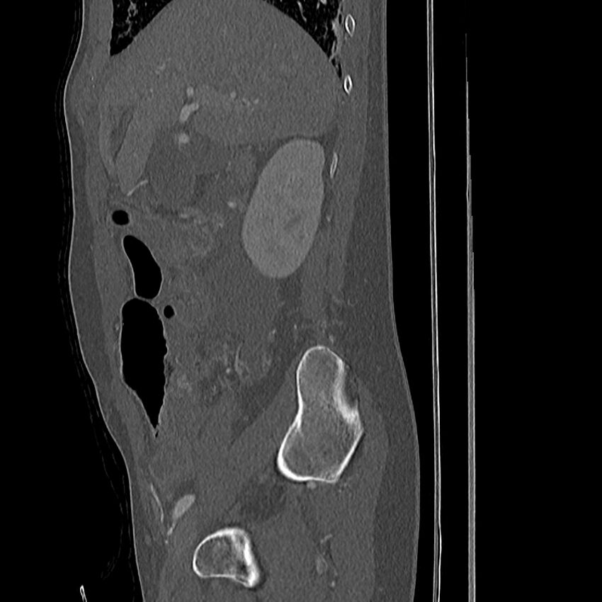 Acute vertebral body compression fractures (Radiopaedia 31757-32693 Sagittal bone window 51).jpg