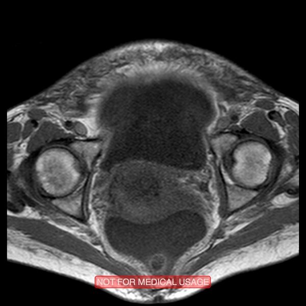 File:Adenocarcinoma of the cervix (Radiopaedia 28373-28615 Axial T1 9).jpg