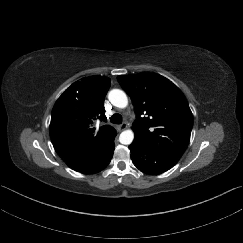 Adenocarcinoma of the lung (Radiopaedia 44205-47803 Axial C+ portal venous phase 31).jpg