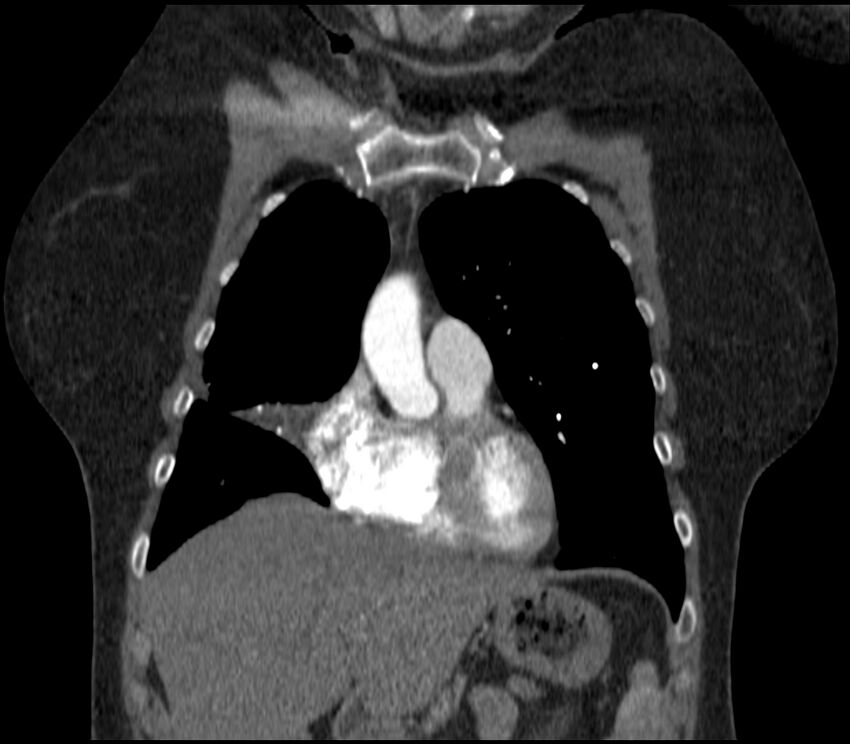 Adenocarcinoma of the lung (Radiopaedia 44205-47803 Coronal C+ portal venous phase 24).jpg