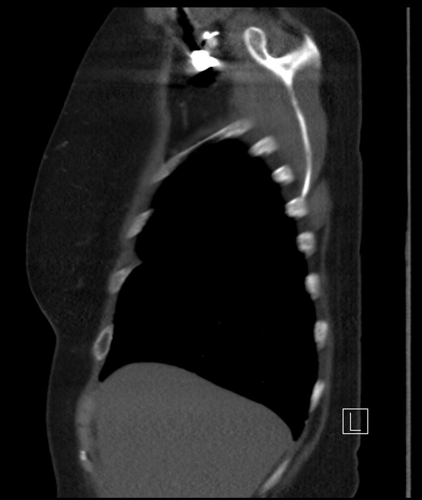 Adenocarcinoma of the lung (Radiopaedia 44205-47803 Sagittal C+ portal venous phase 48).jpg