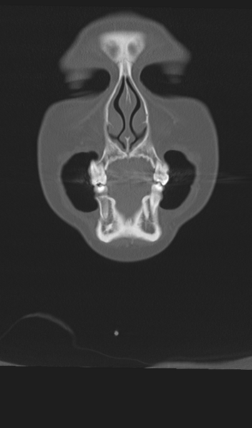 File:Adenoid cystic tumor of palate (Radiopaedia 46980-51518 Coronal bone window 13).png