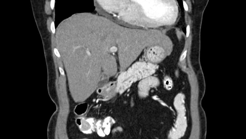 File:Adenomyomatosis of the gallbladder (Radiopaedia 12142-12483 Coronal C+ arterial phase 13).jpg