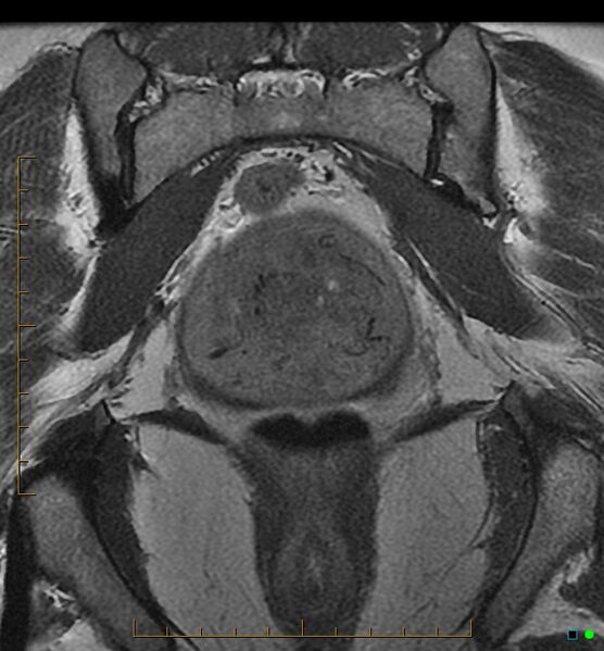 File:Adenomyosis uterus with hematometra (Radiopaedia 45779-50011 Coronal T2 20).jpg