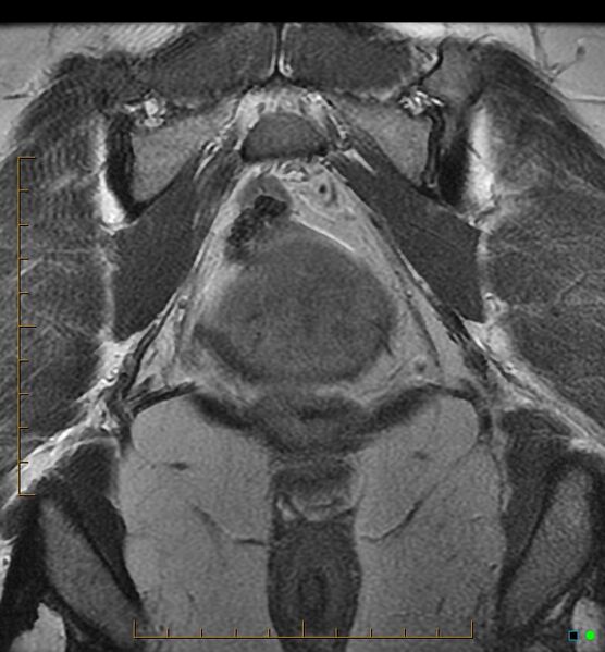 File:Adenomyosis uterus with hematometra (Radiopaedia 45779-50011 Coronal T2 22).jpg