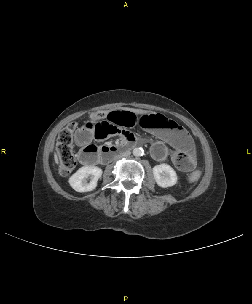 Adhesional small bowel obstruction (Radiopaedia 85402-101024 Axial C+ portal venous phase 137).jpg