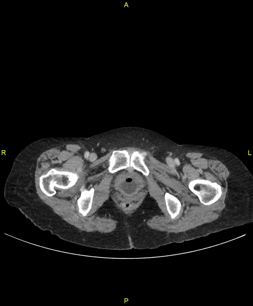 Adhesional small bowel obstruction (Radiopaedia 85402-101024 Axial C+ portal venous phase 291).jpg