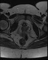 Adnexal multilocular cyst (O-RADS US 3- O-RADS MRI 3) (Radiopaedia 87426-103754 Axial T2 21).jpg