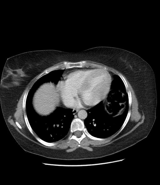 File:Adrenal cortical carcinoma with IVC invasion and thrombosis (Radiopaedia 34307-35597 Axial C+ portal venous phase 5).jpg