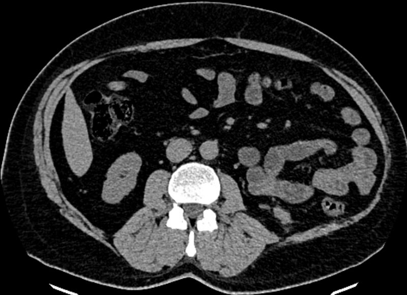 File:Adrenal metastases (Radiopaedia 73082-83791 Axial non-contrast 95).jpg