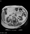 Adrenal myelolipoma (Radiopaedia 6765-7961 Axial T1 in-phase 29).jpg