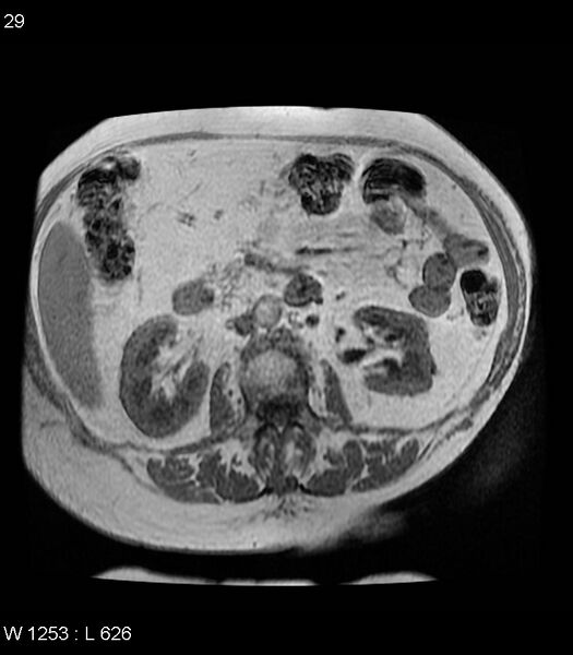 File:Adrenal myelolipoma (Radiopaedia 6765-7961 Axial T1 in-phase 29).jpg