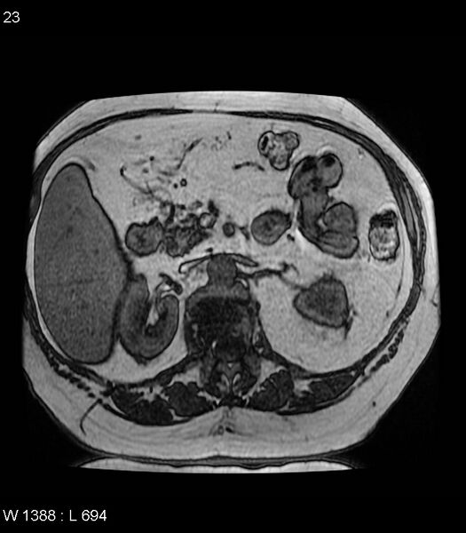 File:Adrenal myelolipoma (Radiopaedia 6765-7961 Axial T1 out-of-phase 23).jpg