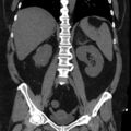 Adrenal myelolipoma (Radiopaedia 8216-9068 non-contrast 9).jpg