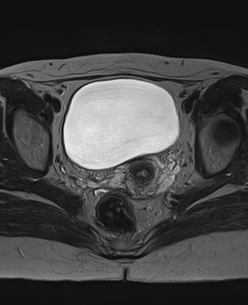 File:Adult granulosa cell tumor of the ovary (Radiopaedia 71581-81950 Axial T2 17).jpg