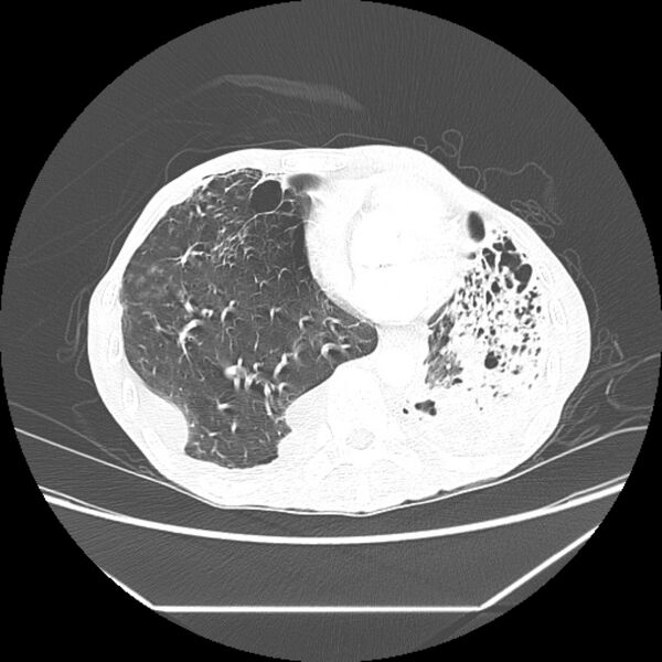 File:Advanced pulmonary tuberculosis (Radiopaedia 8599-9431 Axial lung window 37).jpg