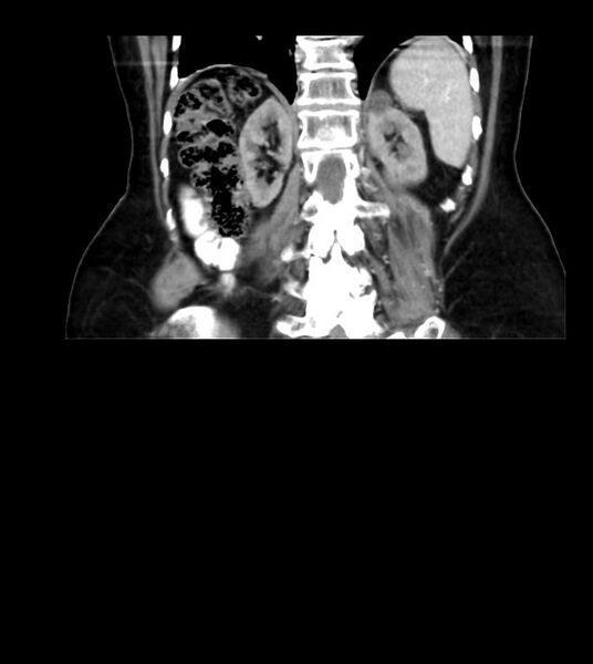 File:Agenesis of the right hepatic lobe (Radiopaedia 78273-90871 D 35).jpg