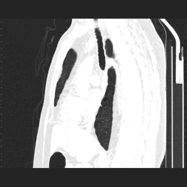 File:Allergic bronchopulmonary aspergillosis (Radiopaedia 21386-21320 Sagittal lung window 10).jpg