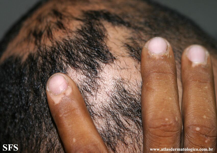 Alopecia Areata And Vitiligo (Dermatology Atlas 10).jpg