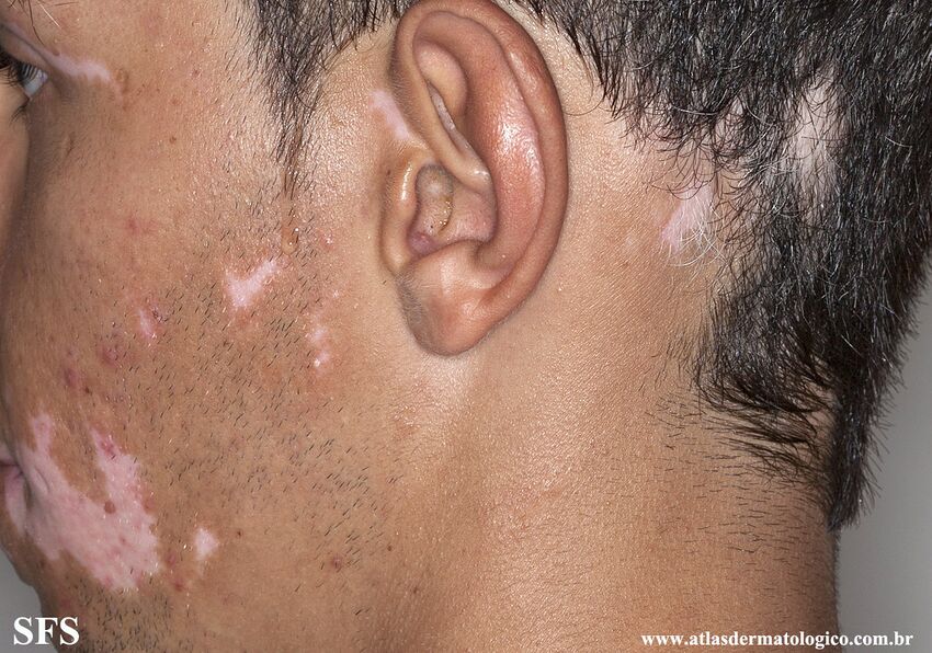Alopecia Areata And Vitiligo (Dermatology Atlas 3).jpg