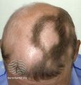 Alopecia areata (DermNet NZ hair-nails-sweat-s-areata5).jpg