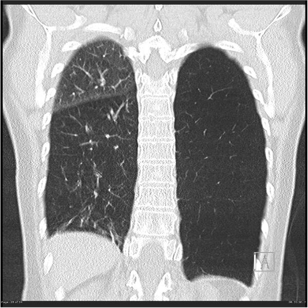File:Alpha-1-antitrypsin deficiency (Radiopaedia 26537-26678 Coronal lung window 28).jpg
