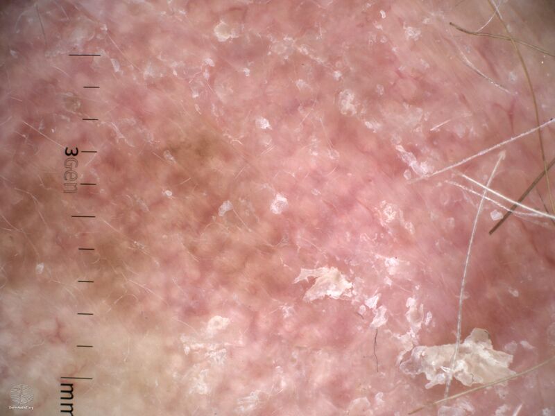 File:Amelanotic melanoma dermoscopy (DermNet NZ actinic-keratosis-dermoscopy3).jpg