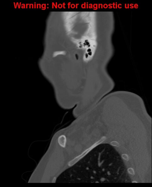 File:Ameloblastoma (Radiopaedia 33126-34164 Sagittal bone window 62).jpg