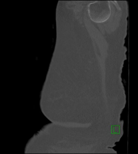 File:Amiodarone deposition in the liver (Radiopaedia 77587-89780 Sagittal bone window 7).jpg